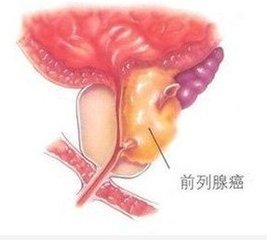 男性前列腺癌的危害有哪些