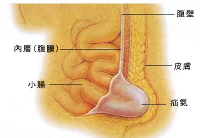 疝气的危害主要是什么