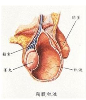 睾丸鞘膜积液