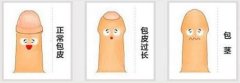包皮包茎手术佳年龄