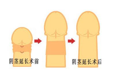 阴茎延长增粗多少钱